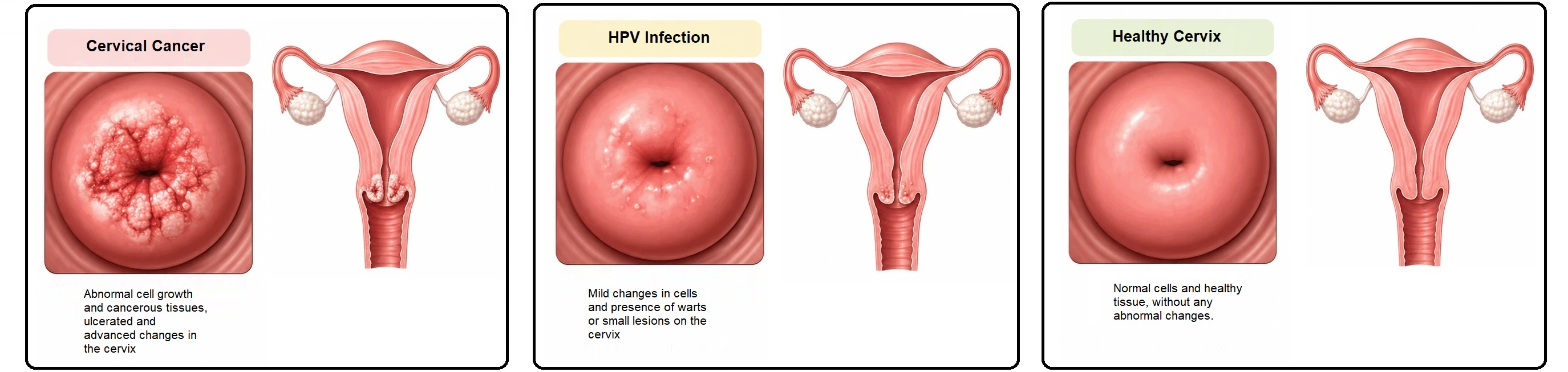 Cervical Cancer, Symptoms and Treatment Methods