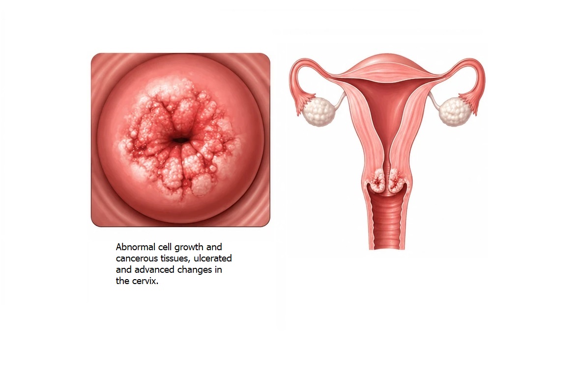 Cervical Cancer
